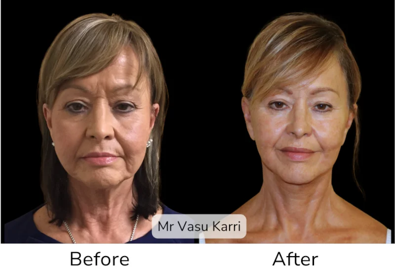 Facelift Patient 7 View 1